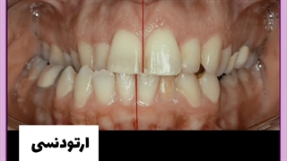 ارتودنسی پیشگیری در کودکان