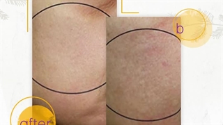 پاکسازی و جوانسازی پوست ماموپلاستی