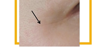 پاکسازی و جوانسازی پوست لیزر صورت