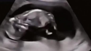 سونوگرافی و حرکت های جنین در ماه های آخر