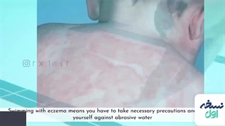 شنا و اگزما پوست - داروخانه آنلاین نسخه اول - داروخانه اینترنتی نسخه اول