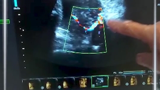 سونوگرافی کالر داپلر