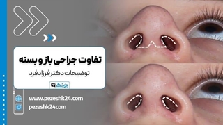 تفاوت جراحی بینی باز و بسته با توضیحات آقای دکتر فرزادفرد دندانپزشکی کودکان