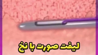 مزایای لیفت صورت با نخ جراحی فک