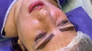 عمل پف پلک در کلینیک آرتین