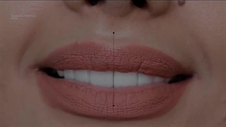 با لمینت دندان بیشتر لبخند بزنید!