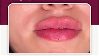 فیلر لب به سبک روسی