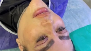 پف چشم در کلینیک آرتین