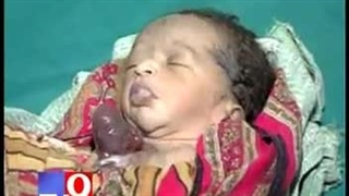 قلب‌نوزادبیرون‌بدن