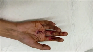 جراحی پارگی تاندون فلکسور عمقی